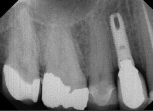 dental implant 2