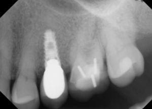 dental implant 3