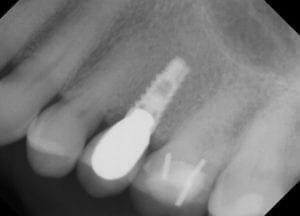 dental implant 4