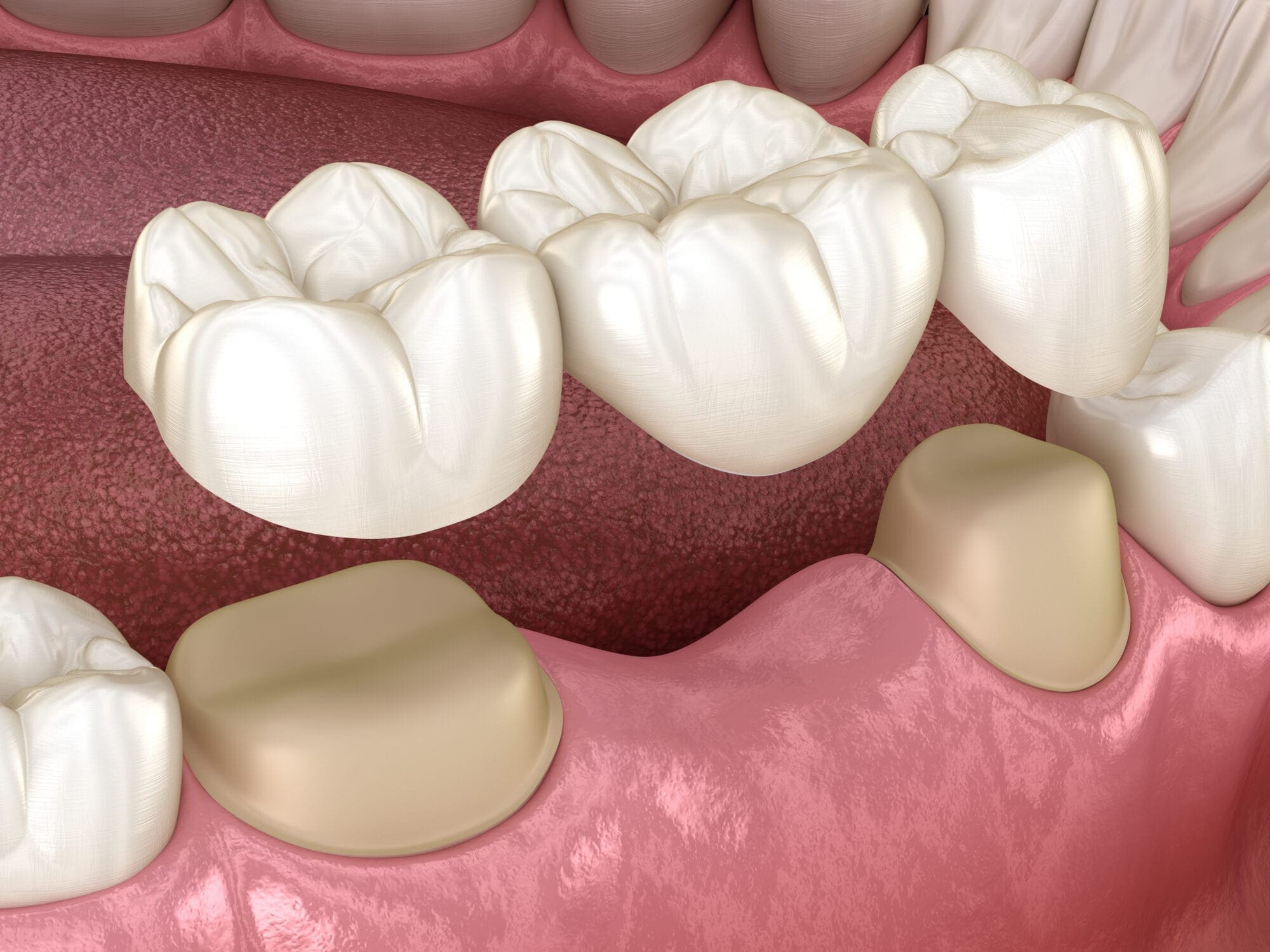 Do Dental Bridges Break Easily