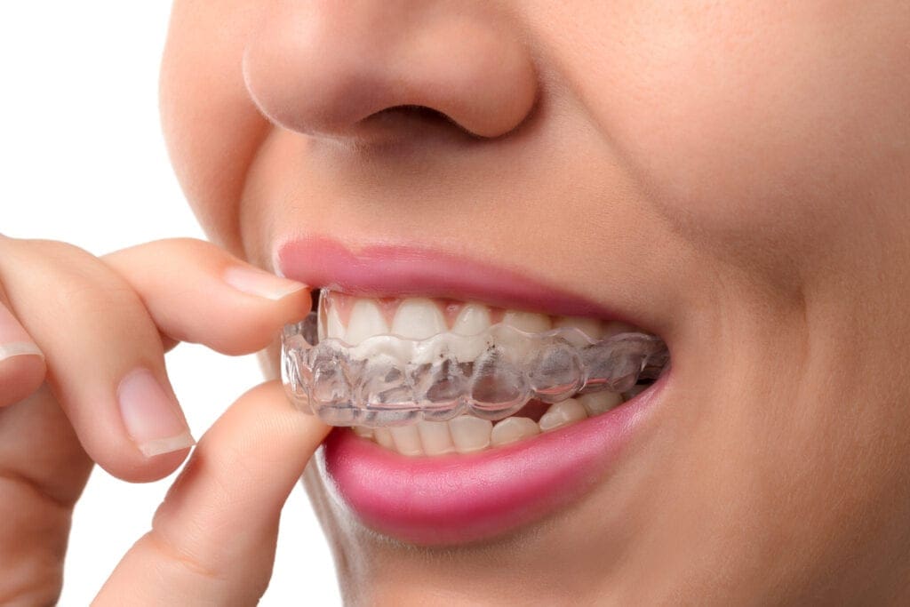 Seattle Invisalign Dentist