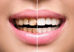 Teeth Whitening at 32 Pearls Seattle Dentist