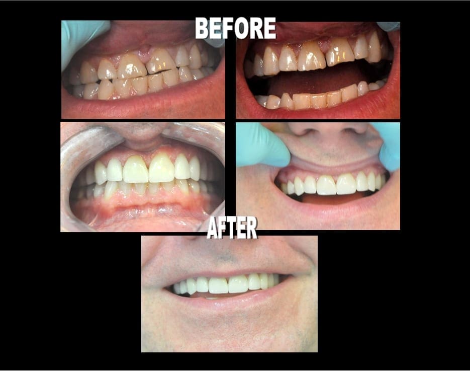 Veneer Before and Afters 32 Pearls Seattle Dentistry