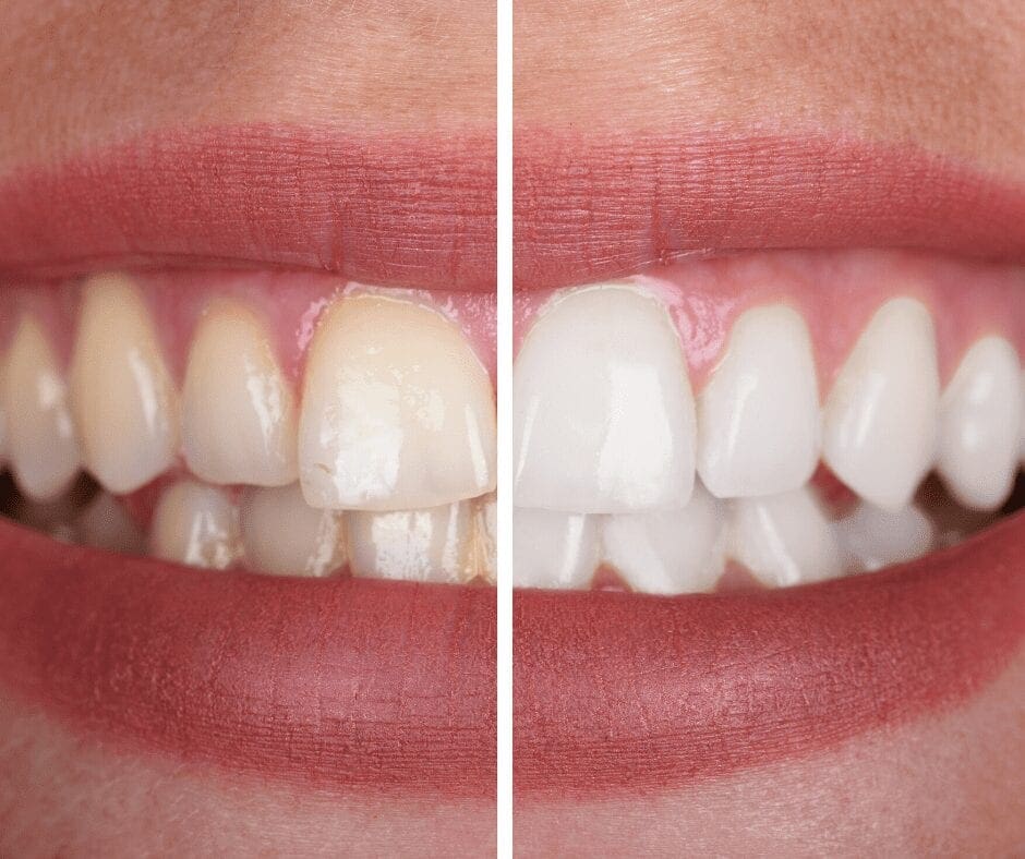 Teeth Whitening Procedure at 32 Pearls Seattle | 32 Pearls