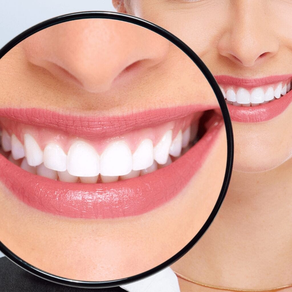 veneer procedures at 32 pearls