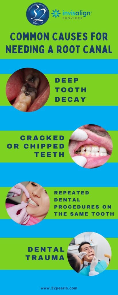 What Is a Root Canal